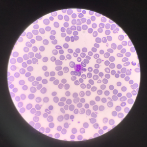 A picture of cells in a purple shade under a microscope - represented in an article about gene and cell therapy for the future of rare disease